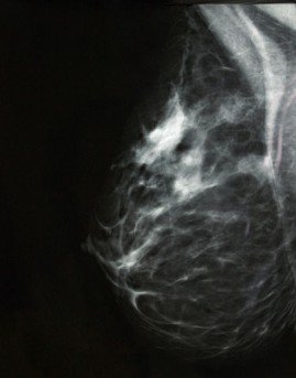 High Dose Rate Brachytherapy for Breast Cancer by OrangeCountySurgeons